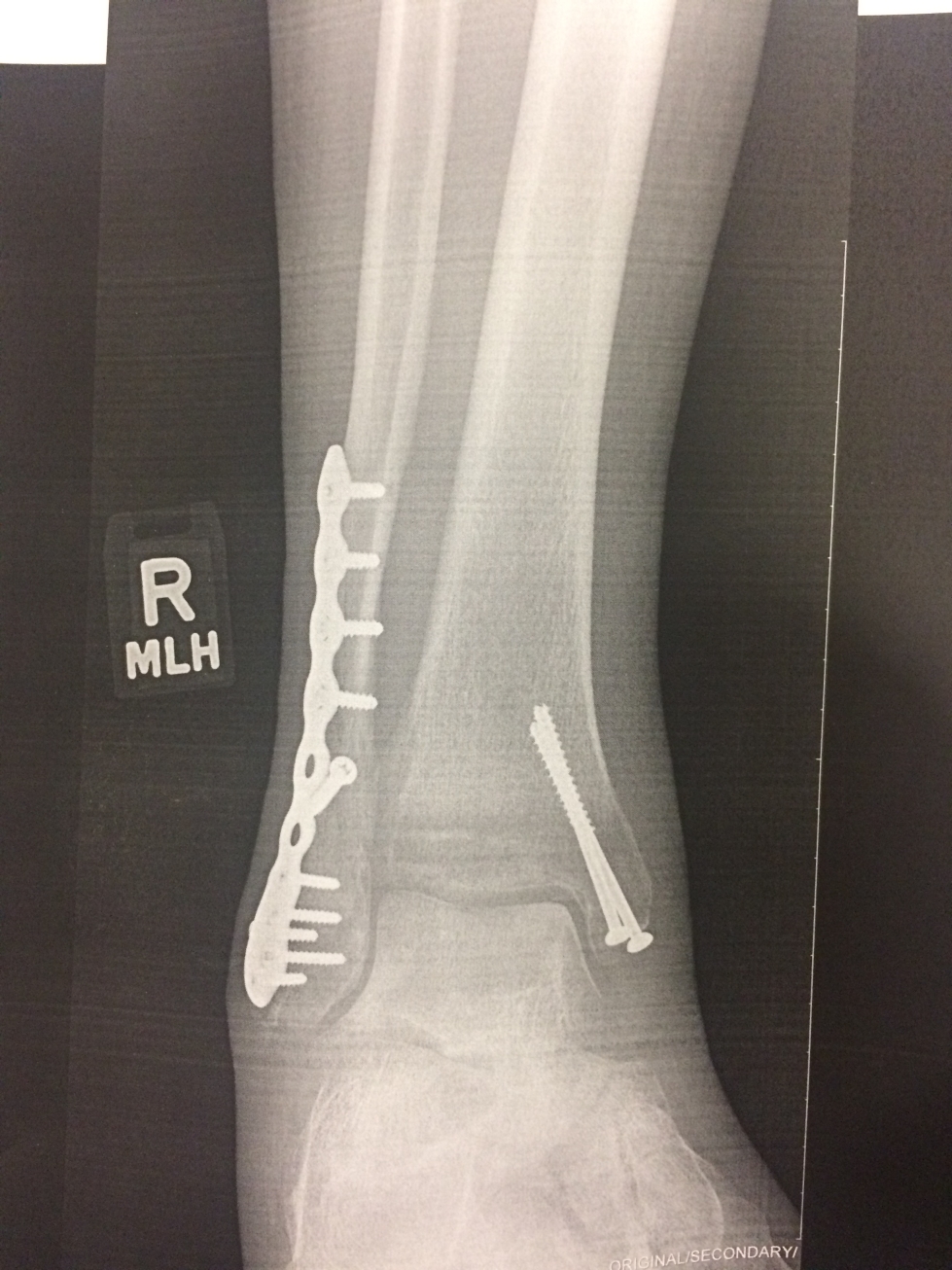 2019 ankle repair